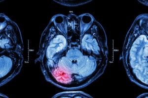 Digital scan of the brain. Why the elderly are more prone to brain injuries and how to prevent them.