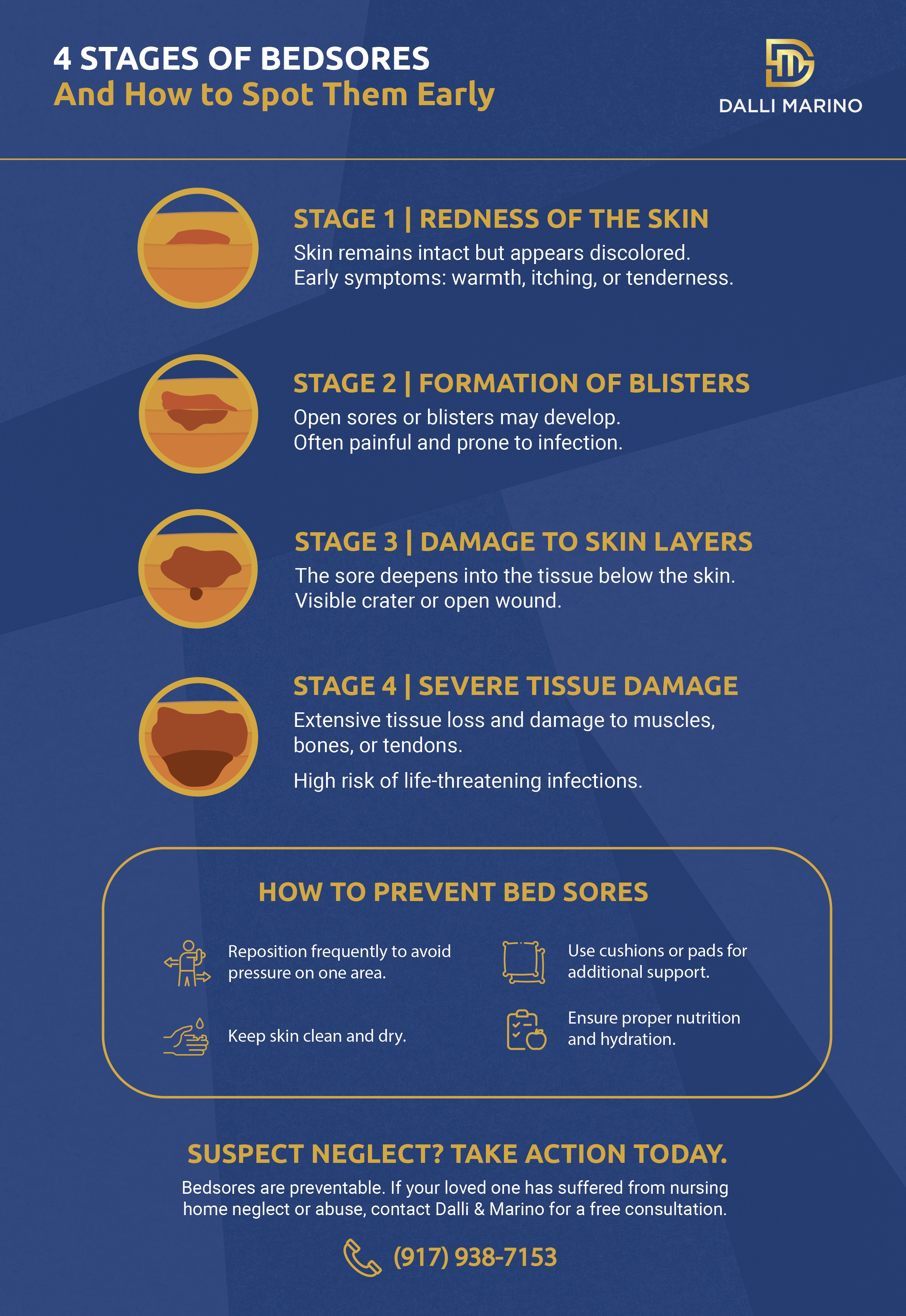 Infographic showing the differences between the 4 stages of bedsores.
