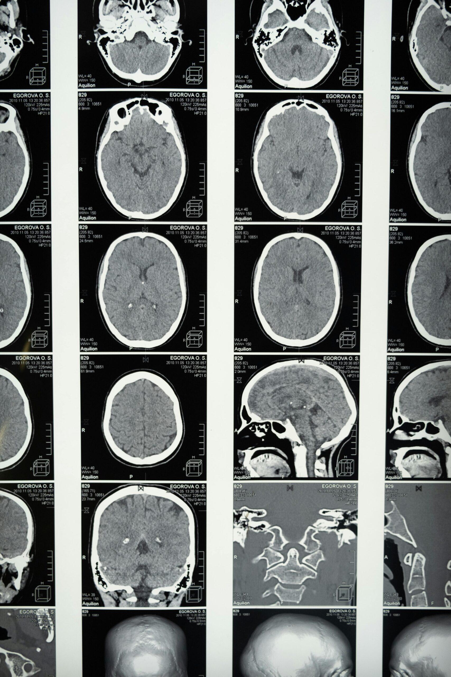brain scan